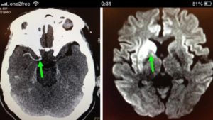 右邊大腦缺血水腫,導致左邊手腳冇力和神智半昏迷 右邊大腦缺血水腫,導致左邊手腳冇力和神智半昏迷