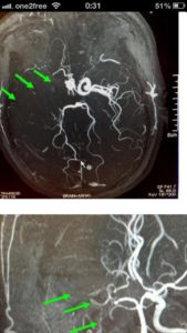 右邊頸和腦部血管大動脈全部都被血栓堵塞着 右邊頸和腦部血管大動脈全部都被血栓堵塞着
