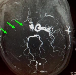 右邊頸和腦部血管大動脈全部都被血栓堵塞着 右邊頸和腦部血管大動脈全部都被血栓堵塞着