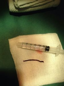 機械式血栓吸取