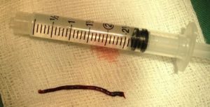 機械式血栓吸取