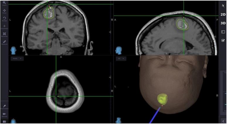 手术在三维立体 3D 电脑导航指导下进行