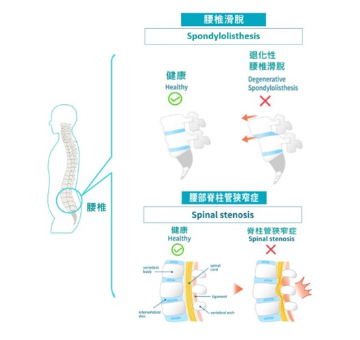 腰部脊椎管狹窄症