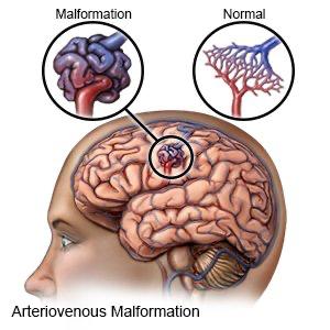 Arteriovenous Malformations