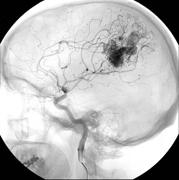 Hemorrhagic Stroke
