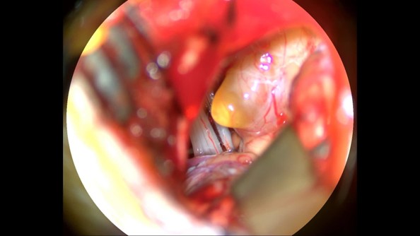 AcousAtic Neuroma Photo