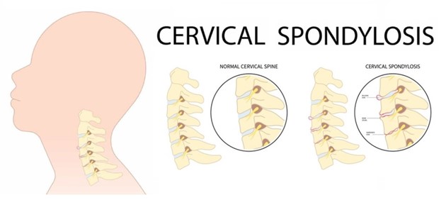 Cervical Spondylosis HKBSSP