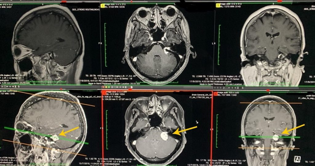 MRI Examination Acoustic Neuroma