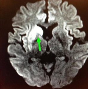 右邊大腦缺血水腫,導致左邊手腳無力和神智半昏迷。