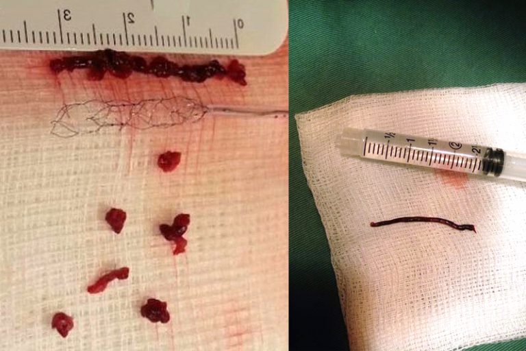 導管遊走到病人右邊的頸和腦部血管大動脈,進行機械式血栓吸取