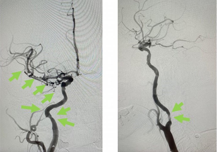 血栓被吸取後, 右頸和腦血管都給順利打通,腦部缺血情況立即得到改善。