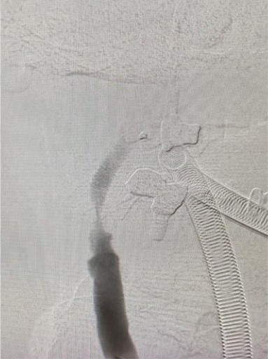 血栓被吸取後,發現右頸內動脈血管嚴重狹窄是中風的主要原因。