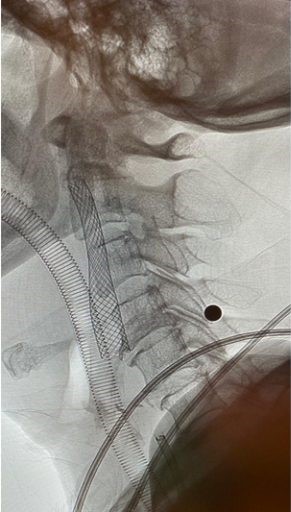 醫生植入血管支架來重新擴張狹窄的血管,以防止將來中風復發。