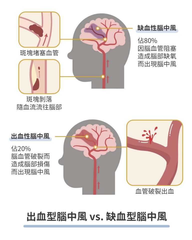 出血性中風 vs 缺血性中風
