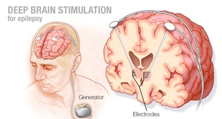 Deep Brain Stimulation for epilepsy