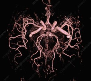 3D腦血管造影 ( MR Angiogram of Brain) 展示雙側腦動脈瘤