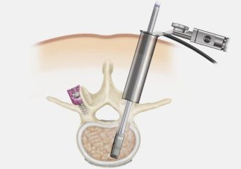 Minimally-Invasive Spine-Surgery-Eng.jpg